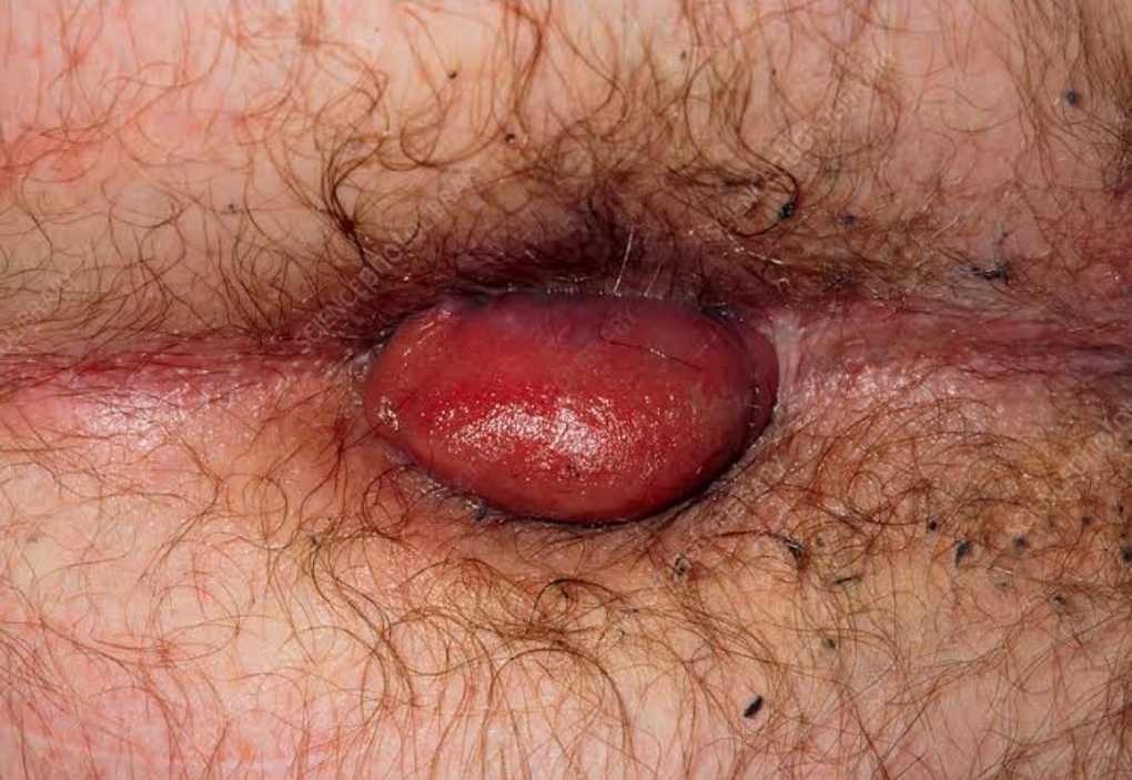 Causes of piles