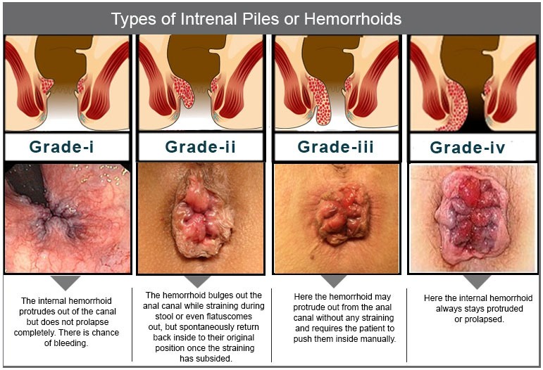 Symptoms of piles